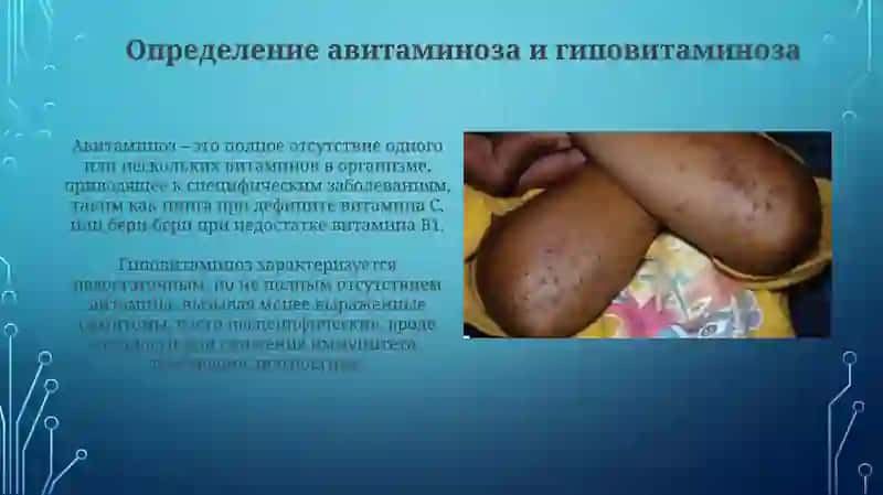 Авитаминозигиповитаминоз 3