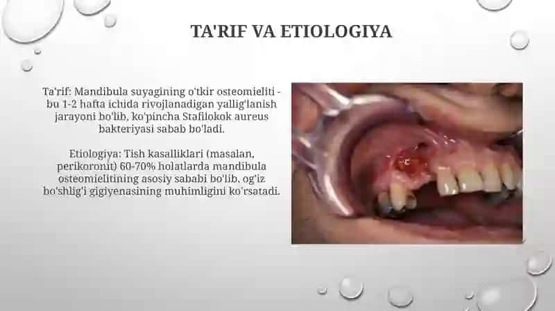 Yiqori jag' o'tkir osteomieliti va atrfidagi rivojlangan abssess va flegmonalari 3
