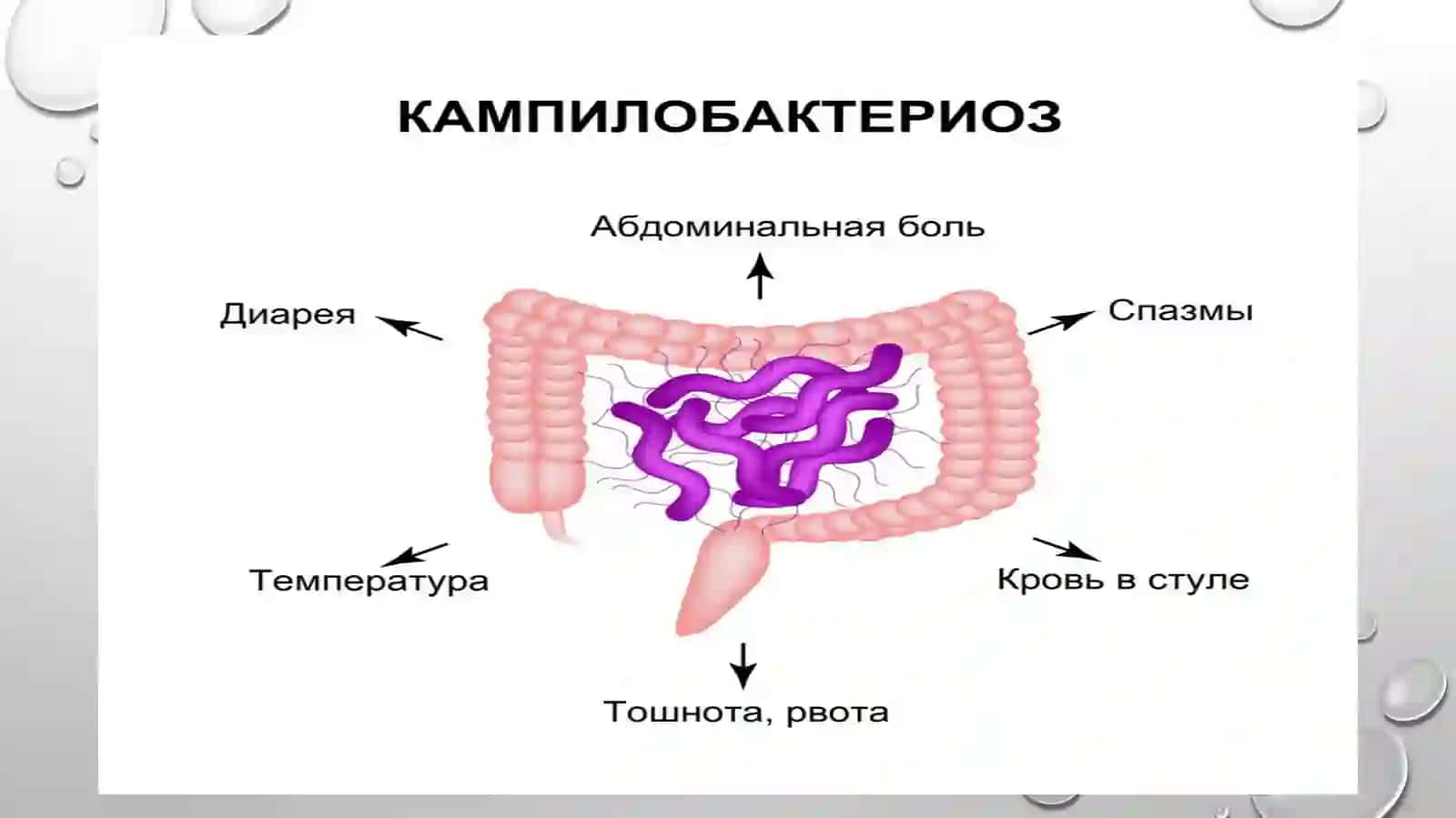 Kampilobakterioz etiologiyasi, epidemiologiyasi, patogenezi, diagnostikasi va davolash 3
