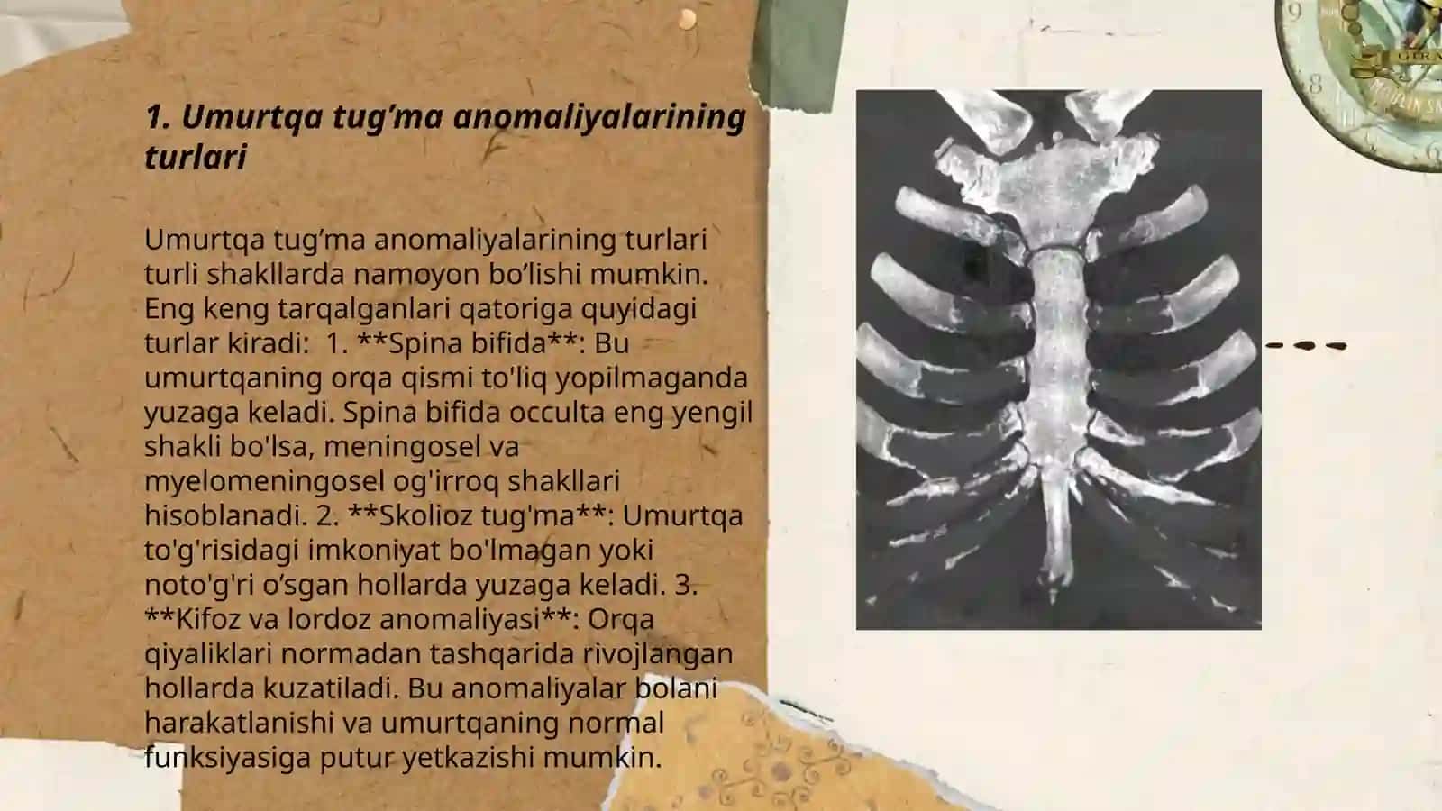 Umurtqa tug’a anomaliyalari 3