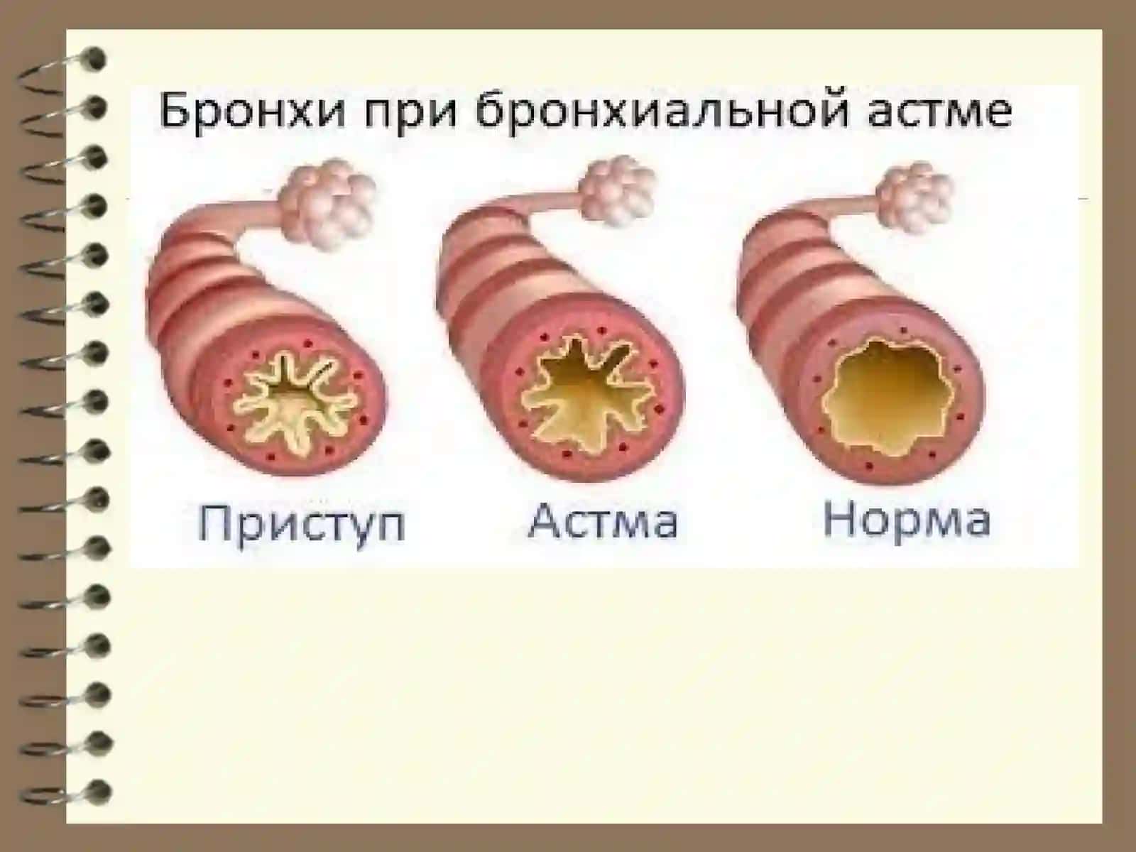 Бронхиал астма.Ўпканинг сурункали обструктив касалликлари.Ўпкаҳавочанлигининг ошиши синдроми.Ўпка эмфиземаси 3