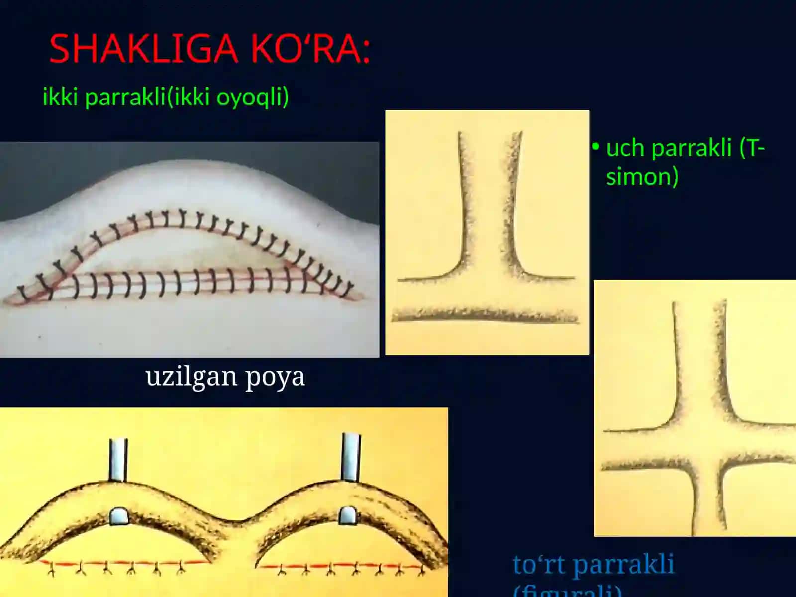 Filatov bandi bilan plastika qilish: Filatov bandini tayyorlashga ko'rsatmalar. Bandni nuqson sohasiga migratsiya qilish bosqichlari. Bandni yoyish. Asoratlar. 3