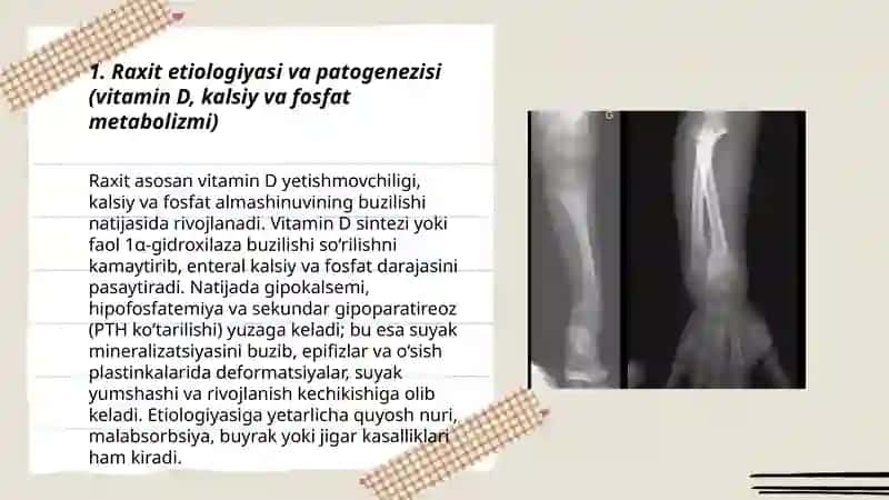 Skeletni raxitik deformatsiyasi. Klinik ko'rinishi va uchrashi. Tashxislash va davolash 3