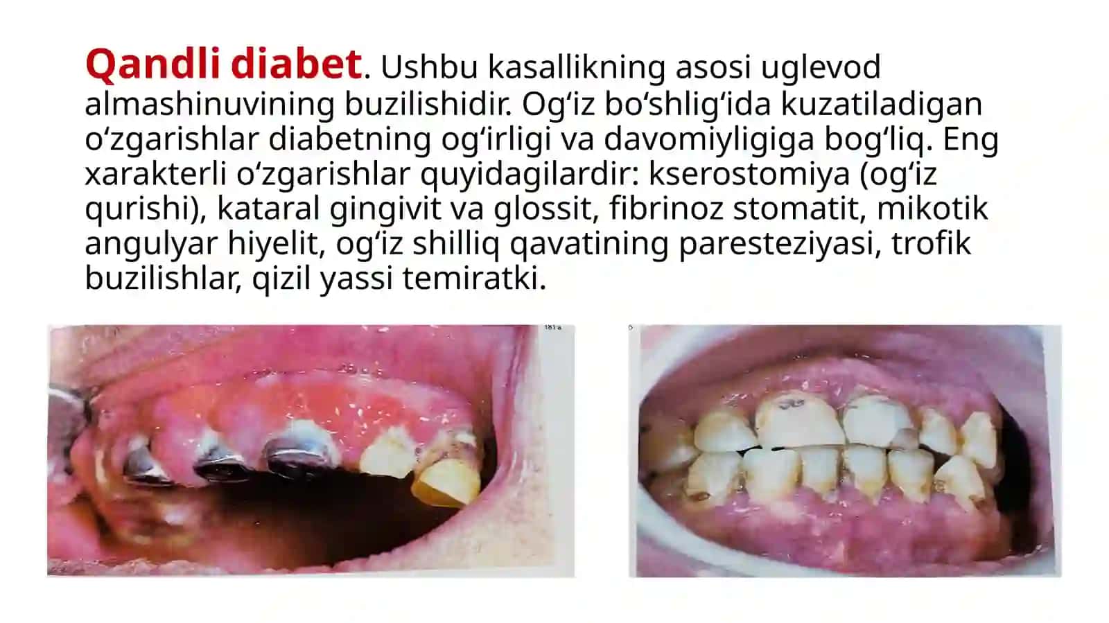Endokrin Sistemasi kasalliklarida og’iz bo’shlig’I shilliq qavatdagi o'zgarishlar 3