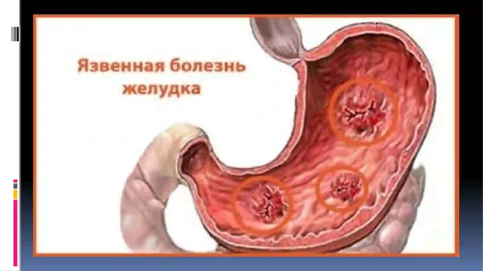 ME'DA VA O`N IKKI BARMOQLI ICHAK YARA KASALLIGI 3
