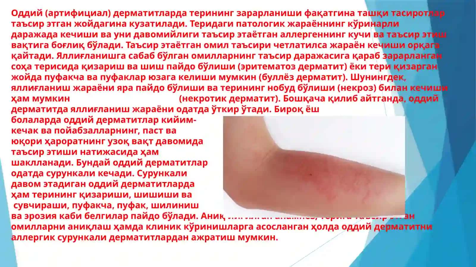 Oddiy va allergik dermatit. Toksik-allergik dermatit. Ekzema 3