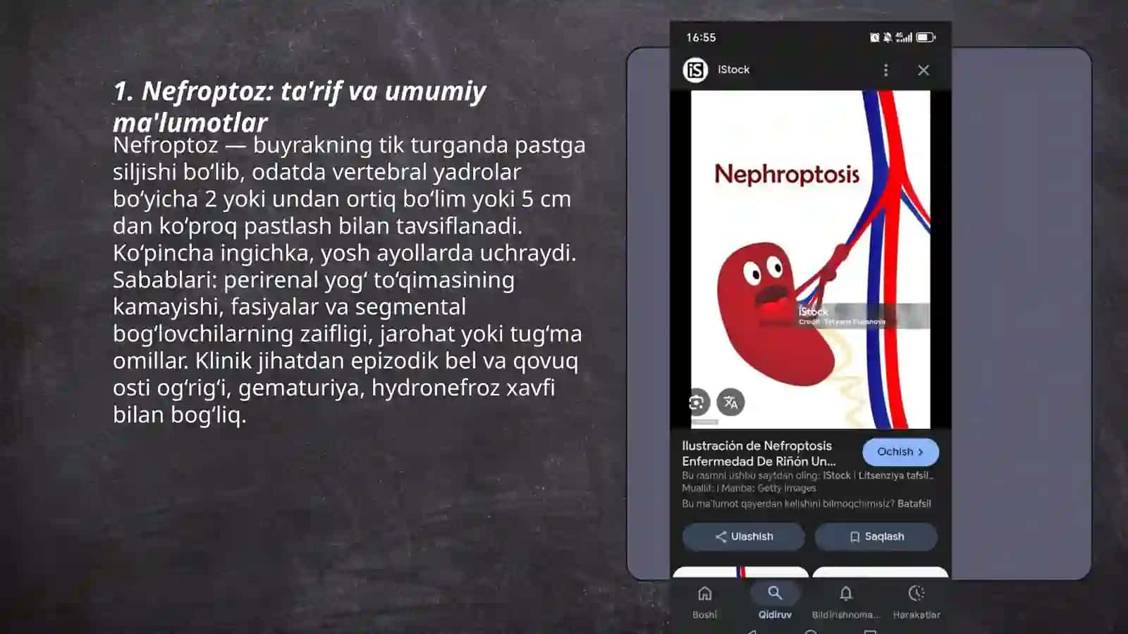 Nefroptoz klinikasi, diagnostikasi, davolash 3