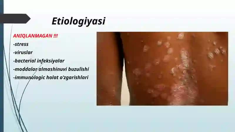 PSORIAZ VA QIZIL YASSI TEMIRATKI QIPIQLI TEMIRATKI (PSORIASISVULGARIS) 3