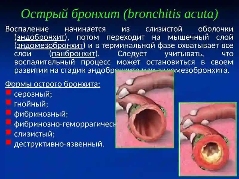 Болезни органов дыхания. Туберкулёз 3