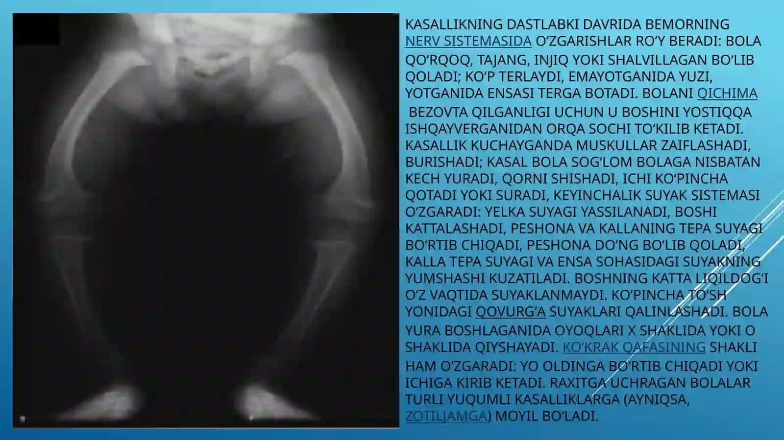 Raxit kasalligi 3