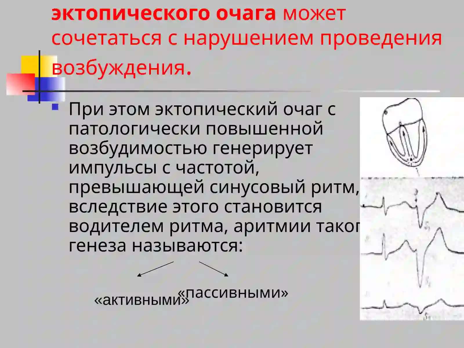 Нарушение возбудимости сердца 3