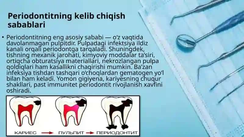 O‘tkir va surunkali periodontitlarni ambulator sharoitda davolash. O‘tkir periodontit shakllarida 3