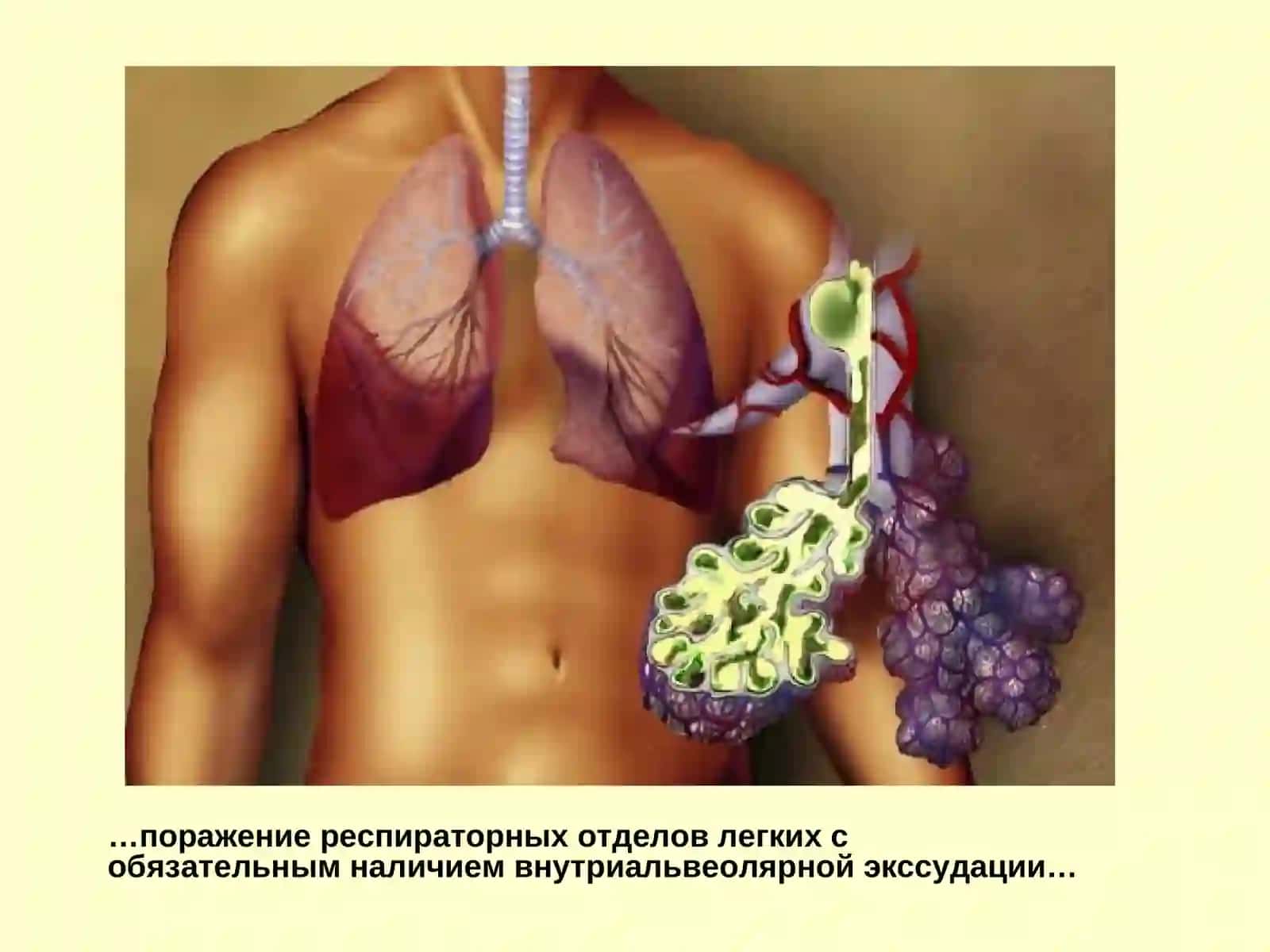 Внебольничная пневмония: диагностика и лечение 3