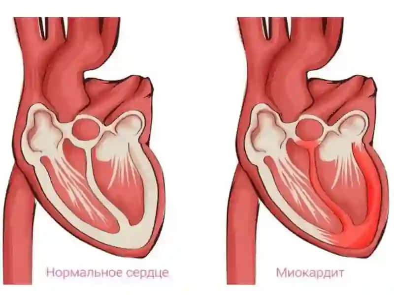 Miokardit va miokardiodistrofiyalarni  etiologiyasi, patogenezi va davolash  usullari. Miokardit va  miokardiodistrofiyalarni davolashda  qo‘llaniladigan dori vositalarning  farmakodinamikasi. 3