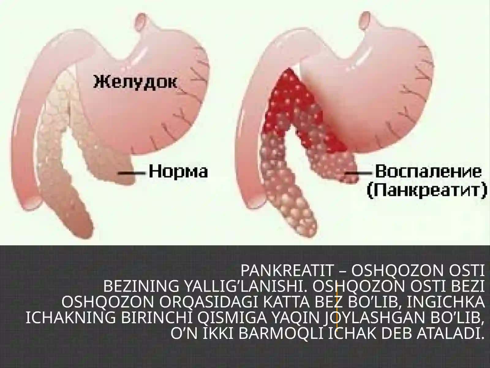 PANKREATITLARNI XIRURGIK DAVOLASH USULLARI 3