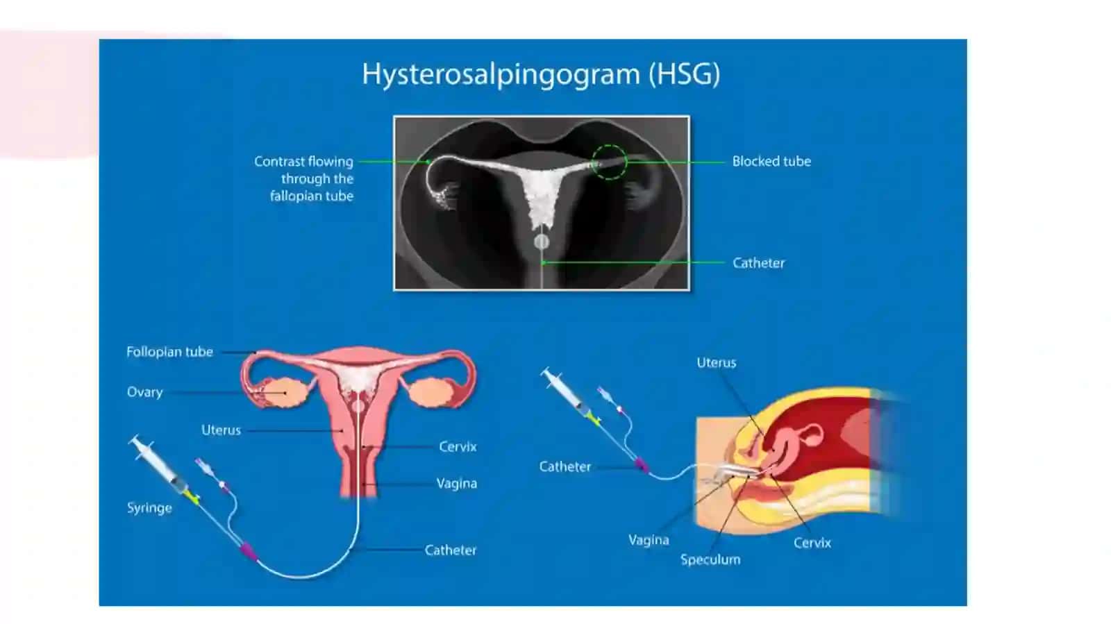 Gistrosalpingografiya 3