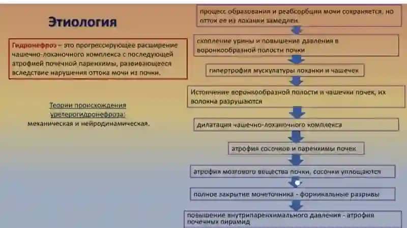 Гидронефроз 3