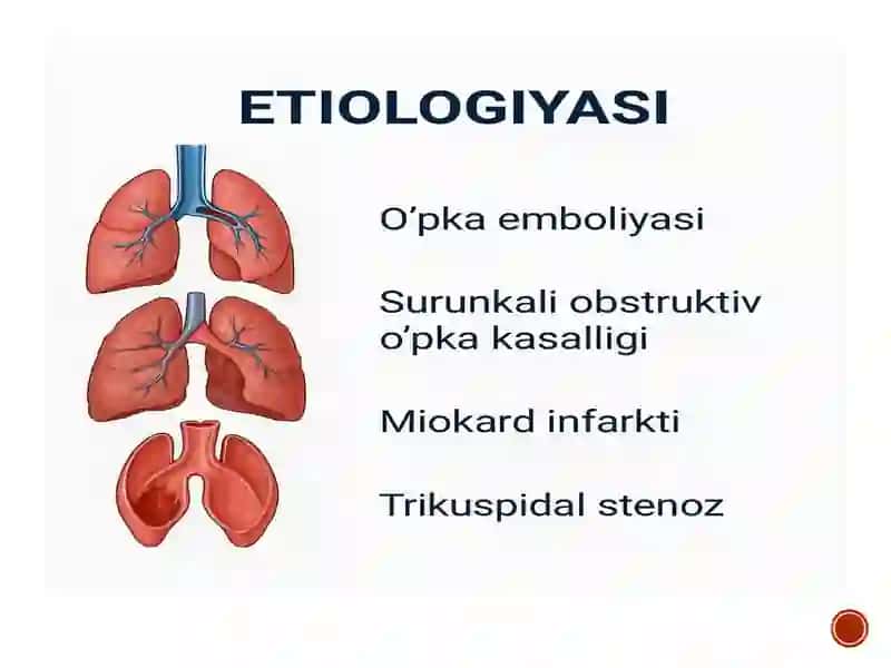 O‘NG QORINCHA YETISHMOVCHILIGI: ETIOLOGIYASI, PATOGENEZI, KLINIK MANZARASI VA EKG O‘ZGARISHLARI 3