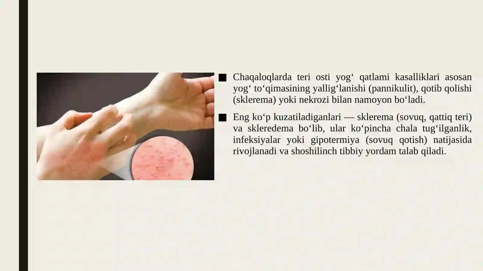 Chaqaloqlarda teri osti yog‘ qatlami kasalliklari 3