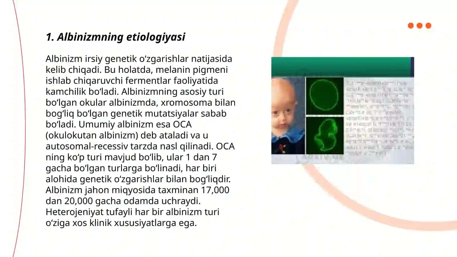 Albinizim.Etiopatogenezi, klinikasi,diagnostikasi, davolash va profilaktikasi 3