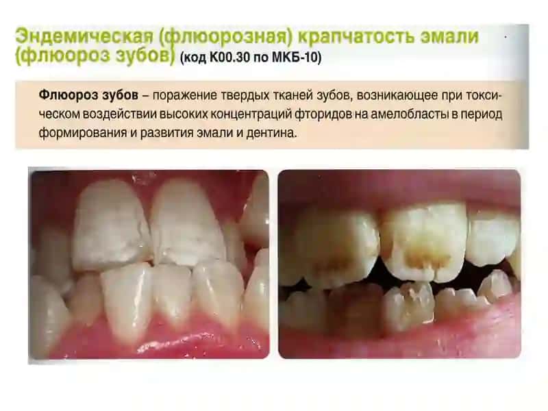 Профилактика некариозных поражений 3