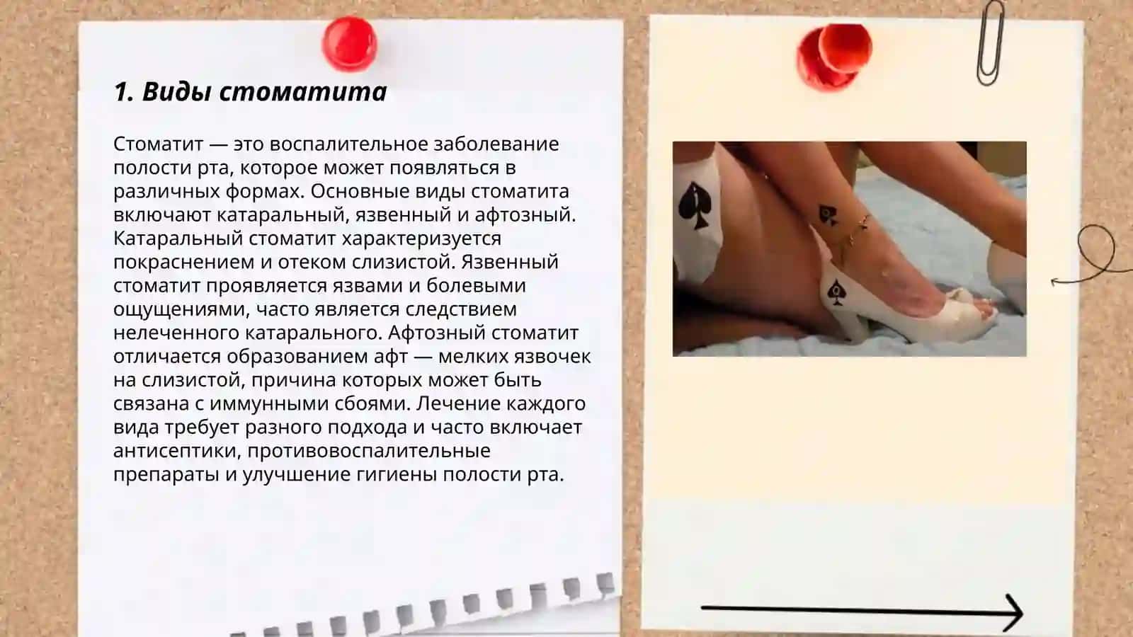 Стоматит кассалиги 3