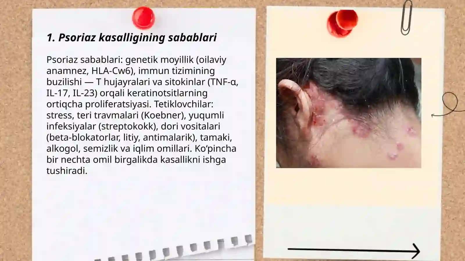 Psoriaz kasalligi 3