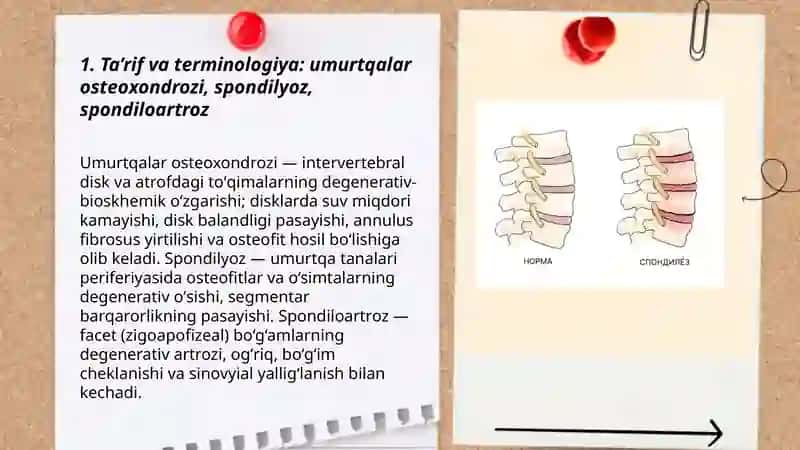 Umurtqalar osteoxondrozi. Spondilyoz. Spondiloartroz. 3