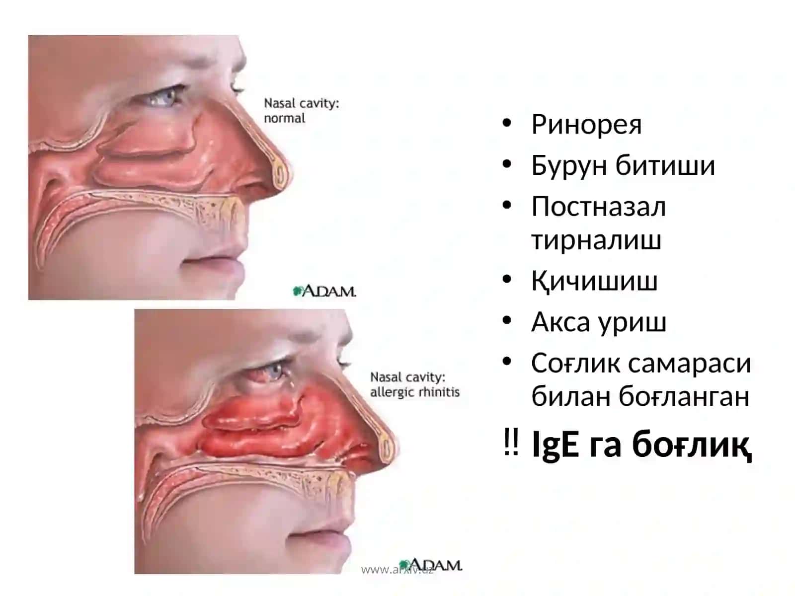 Аллергик ринит 3