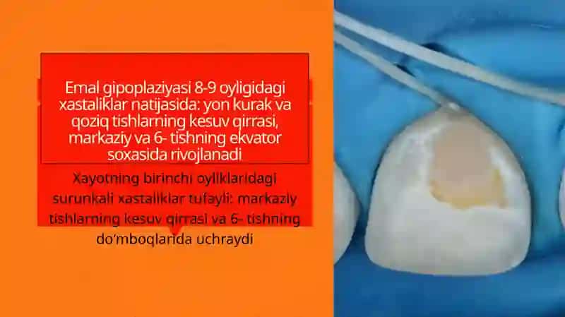 Tishlarni nokarioz kasalliklari: Emal gipoplaziyasi 3