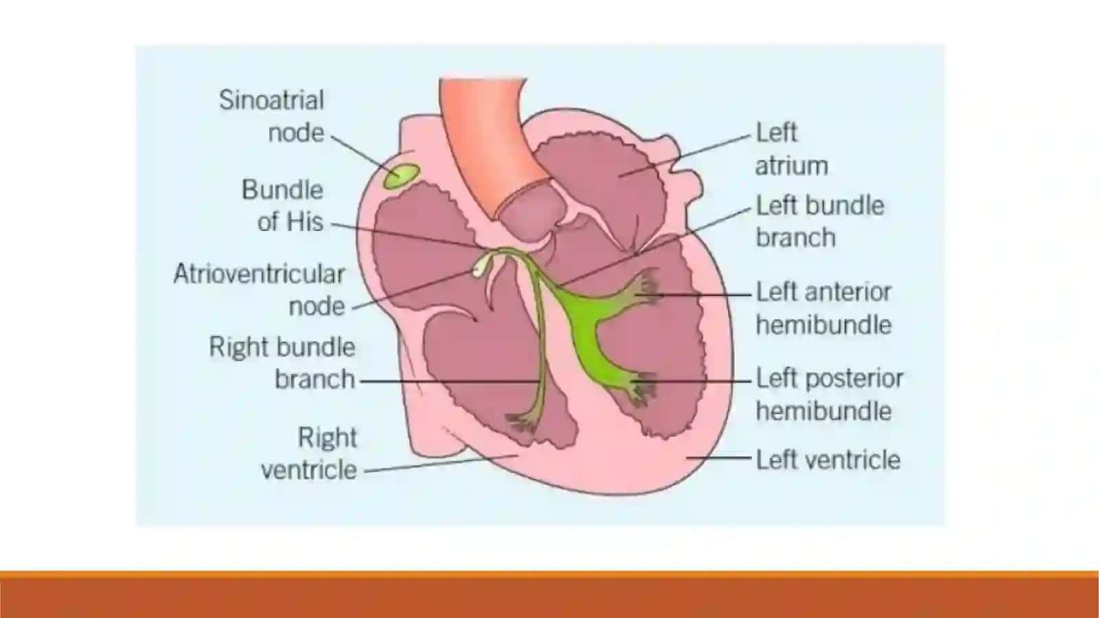 Sinoatrial blokada 3
