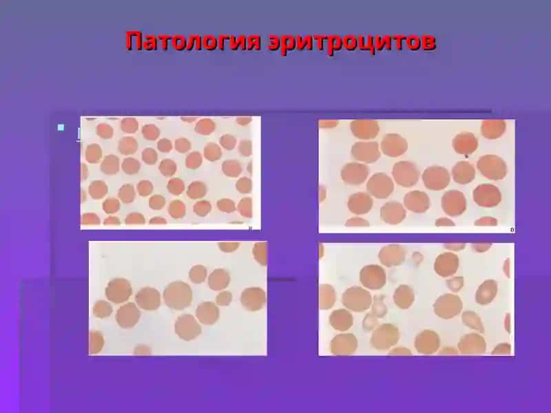 Анемия 3
