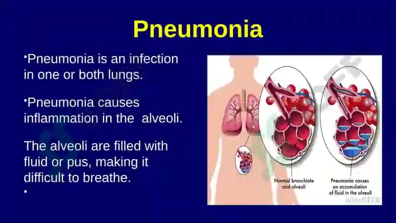 Pneumonia 3