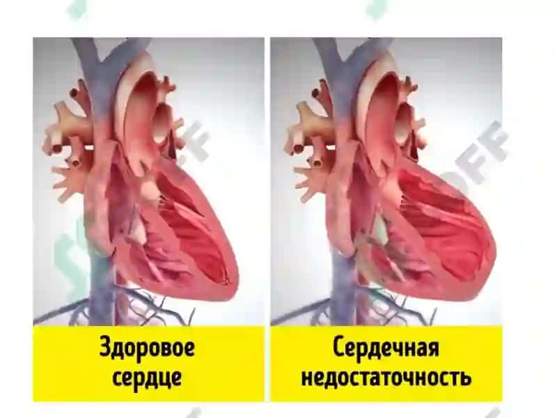 YURAK   YETISHMOVCHILIGI 3