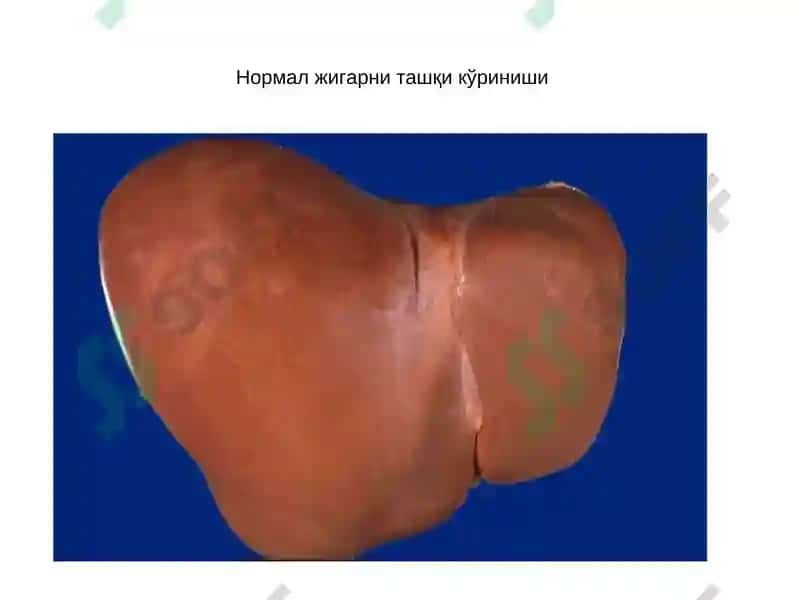 Жигар касалликларидаги асосий клиник синдромлар 3