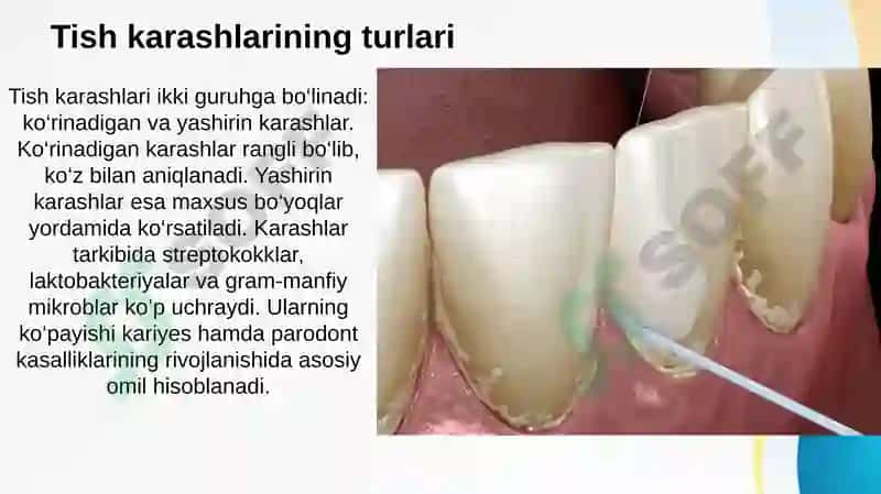 Tish karashlari. Tish karashlarini tozalash usullari, asbob-uskunalar. Parodont to’qimasini patologiyasi bor bemorlarni tekshirish usullari (asosiy va qo’shimcha usullar). Parodont to’qimasini tuzilishi, funksiyasi. Parodont kasalliklarini tasnifi 3