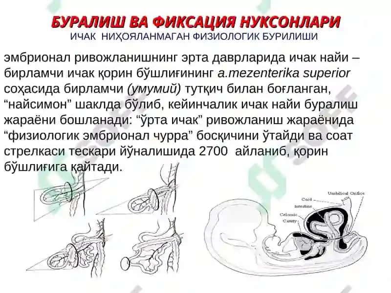 Қорин парда кин усимтасининг тугма ривожланиш нуксонлари ва аномалиялар ва чурралар 3
