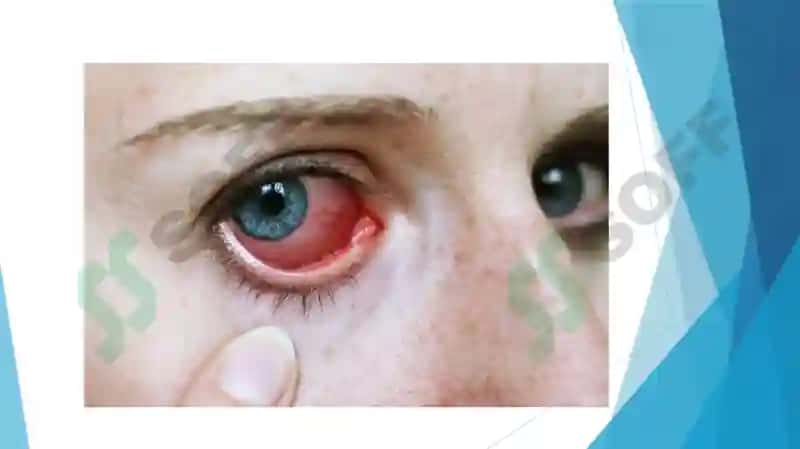 Uveitlardagi ko'rish pasayishi va korklikning profilaktikasi 3