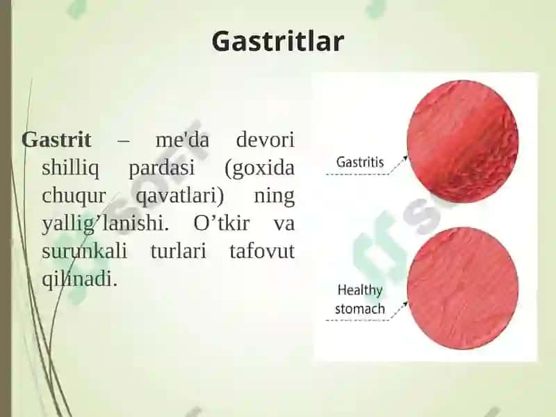 GASTRIT 3