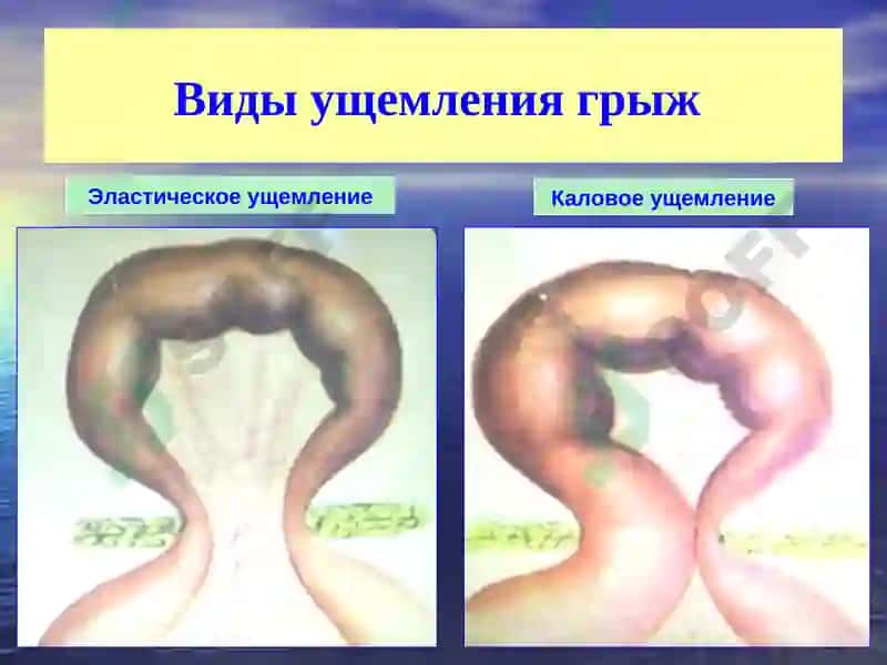 Осложнения грыж живота 3