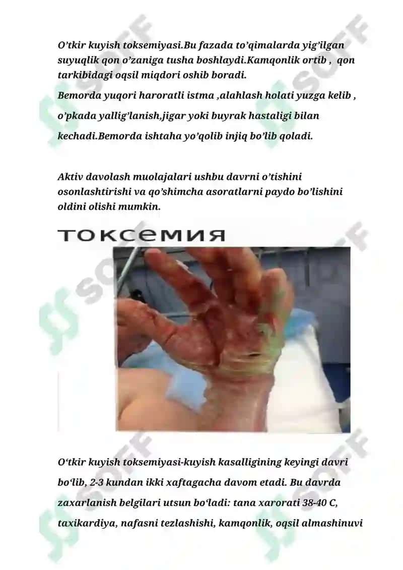 KUYISH KASALLIGI VA DARAJALARI.BEMORLARNING PARVARISHI 3