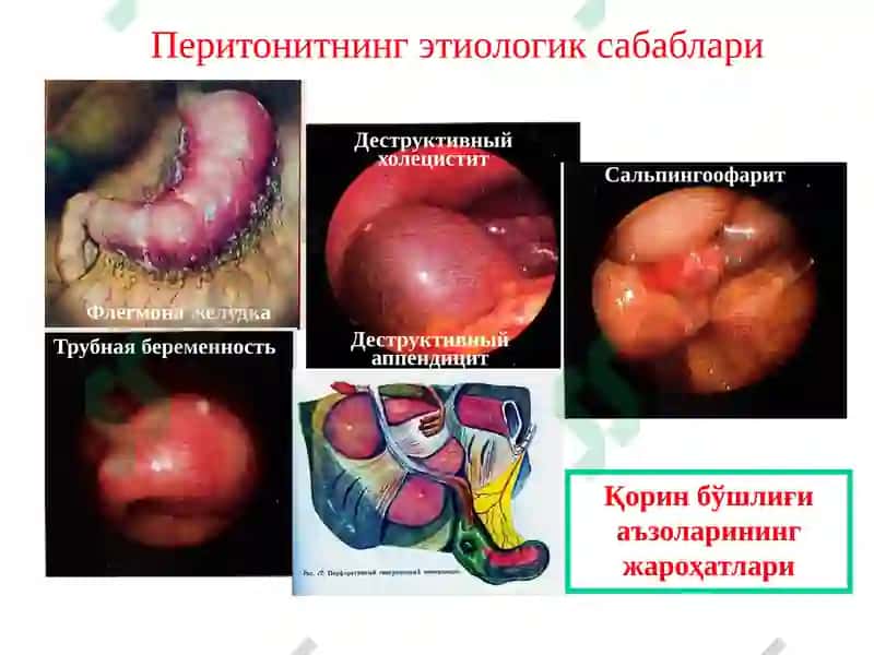 Ўткир перитонит 3