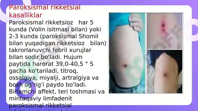 RIKKETSIOZ KLINIKASI 3