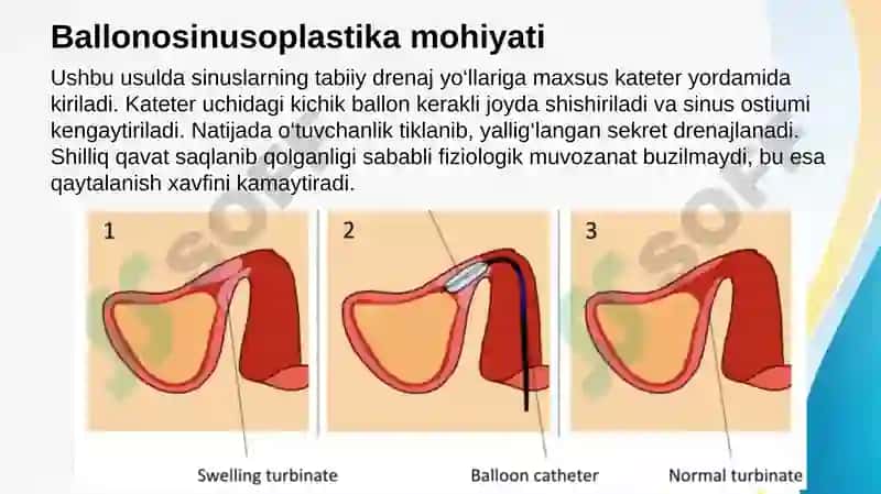 Ballonosinusoplastika 3