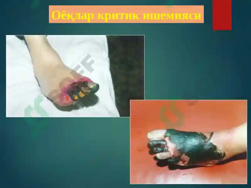 Оёқ артериялари сурункали облитерацияловчи касалликларини учрашфоизи 3