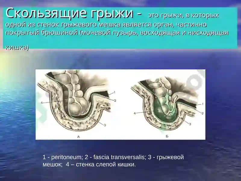 ГРЫЖИ ЖИВОТА 3
