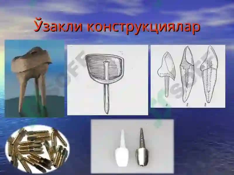 Тиш  тож  қисмининг  қисман ва  тўлиқ йўқотилганда   ўзакли конструкциялар билан тиклаш. 3
