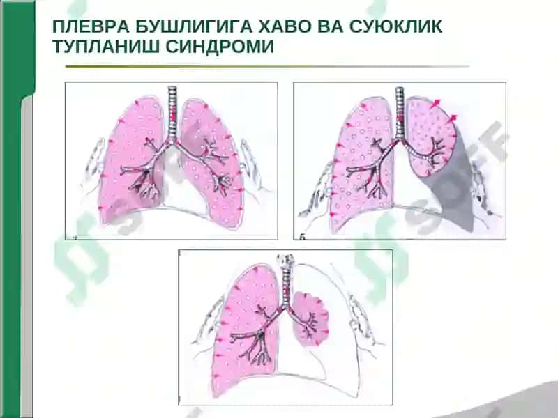 Плевра Бушлигига Хаво ва Суюклик Тупланиш Синдоми 3