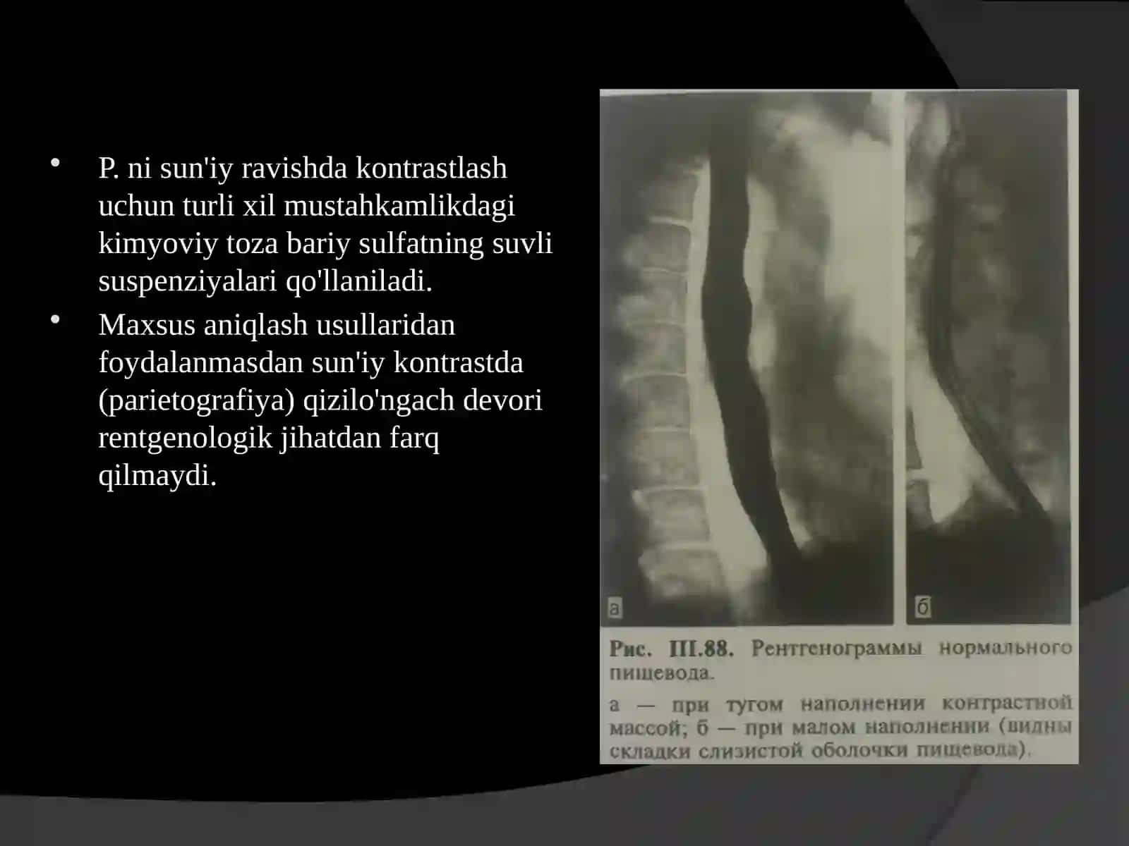 Oshqozon-ichak traktining rentgenologik anatomiyasi va rentgenopatologiyasi 3