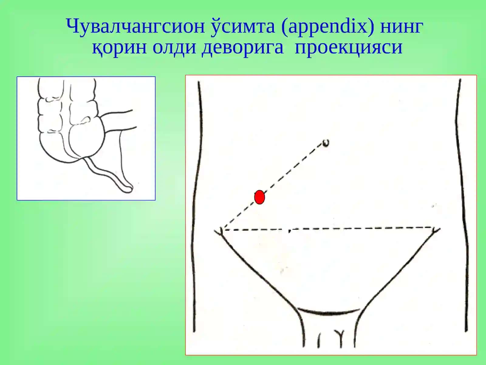 Аппендицит асоратлари 3